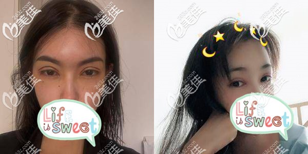 切開雙眼皮術后5天，腫到懷疑人生