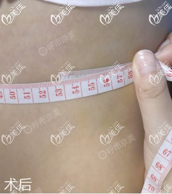 呼和浩特抽脂好的醫(yī)院我推薦京美,在京美做了水動(dòng)力腰腹吸脂2000ml后我的肚子瘦了一大圈!