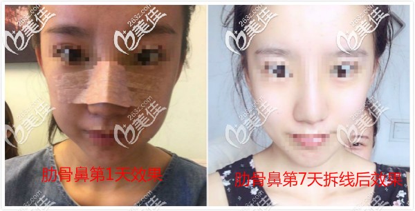 肋骨鼻一到七天圖