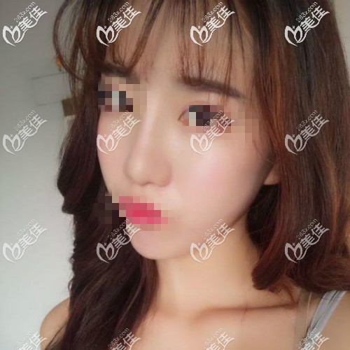 做肋骨鼻3個(gè)月恢復(fù)期好痛苦,鼻子又寬又腫很丑,恢復(fù)3到6個(gè)月才變好看