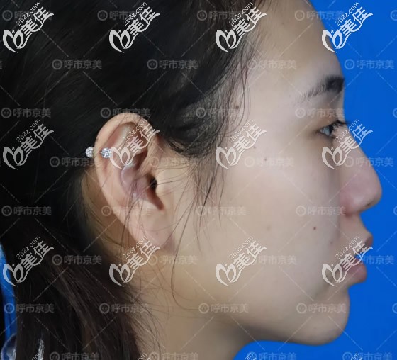 呼和浩特京美整形醫(yī)院耳軟骨隆鼻前 呼和浩特京美整形醫(yī)院耳軟骨隆鼻前