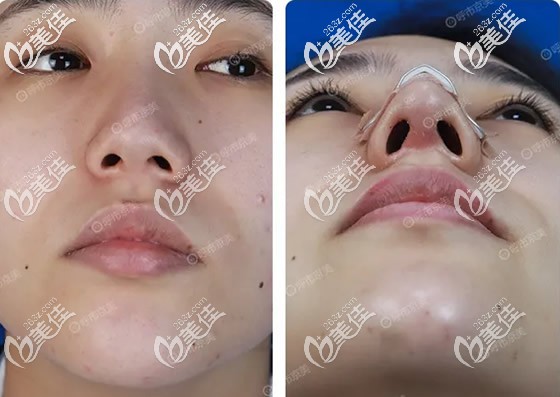 自體耳軟骨隆鼻前后對比照片 自體耳軟骨隆鼻前后對比照片