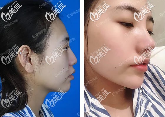 京美馬曉艷醫(yī)生鼻綜合隆鼻7天拆線后效果 京美馬曉艷醫(yī)生鼻綜合隆鼻7天拆線后效果