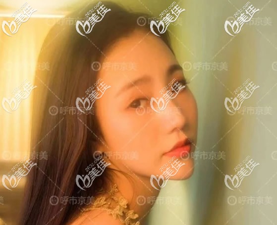 我整鼻子經(jīng)歷證明:耳軟骨隆鼻半年基本沒了、耳軟骨墊鼻尖鼻頭肥厚鼻子硬,不是每個(gè)人都有哦！