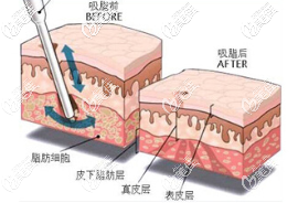 吸脂示意圖 吸脂示意圖