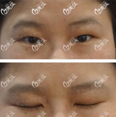 雙眼皮開眼角術前照 雙眼皮開眼角術前照