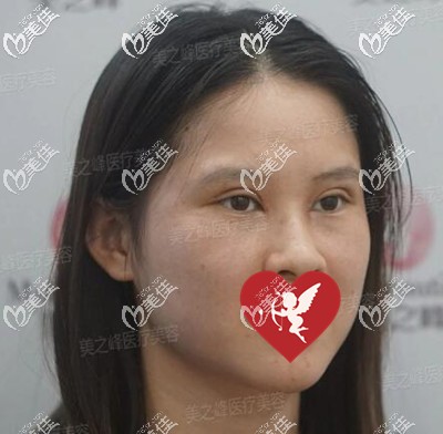 雙眼皮開眼角眼綜合術后8天拆線 雙眼皮開眼角眼綜合術后8天拆線