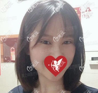 眼綜合術后1個月時的恢復效果圖 眼綜合術后1個月時的恢復效果圖