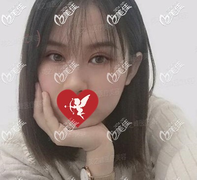 在長沙做眼綜合術后2個月時的恢復效果照 在長沙做眼綜合術后2個月時的恢復效果照