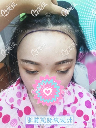 發(fā)際線脫落后移形成大腦門 發(fā)際線脫落后移形成大腦門