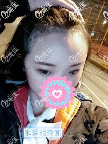 種植發(fā)際線有危險嗎?來分享一下我做發(fā)際線種植后30天的生發(fā)經(jīng)歷過程