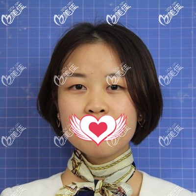 做雙眼皮手術(shù)前的我 做雙眼皮手術(shù)前的我