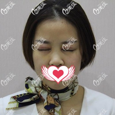 雙眼皮術(shù)后一周拆線 雙眼皮術(shù)后一周拆線