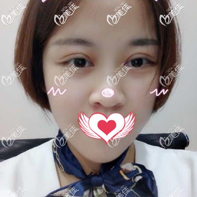 術(shù)后一個(gè)月效果分享 術(shù)后一個(gè)月效果分享