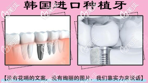 成都君臣口腔種植牙怎么樣 成都君臣口腔種植牙怎么樣