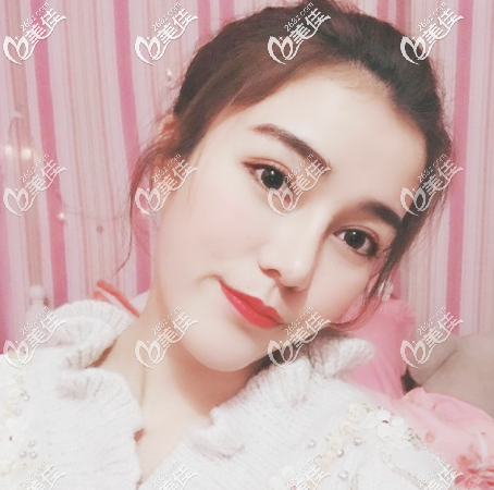 廣州美萊劉豪做鼻子怎么樣?我的肋軟骨隆鼻子案例或許可以給你參考