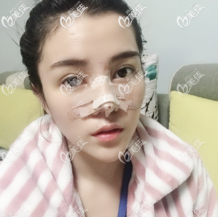 廣州美萊劉豪肋軟骨隆鼻5天<span style= 廣州美萊劉豪肋軟骨隆鼻5天<span style=