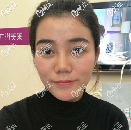 找廣州美萊劉豪做鼻子術(shù)前照片 找廣州美萊劉豪做鼻子術(shù)前照片