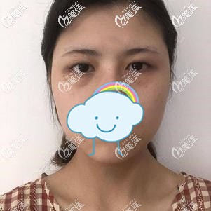 做眼綜合術(shù)前多種情況的眼部情況 做眼綜合術(shù)前多種情況的眼部情況