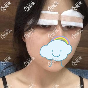 做完眼綜合后的手術(shù)效果 做完眼綜合后的手術(shù)效果