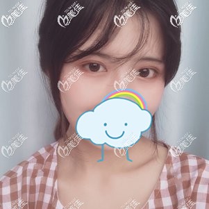 做切開雙眼皮+開眼角術(shù)后45天腫脹漸消 做切開雙眼皮+開眼角術(shù)后45天腫脹漸消