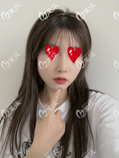 青島諾美德假體隆鼻半個(gè)月的樣子