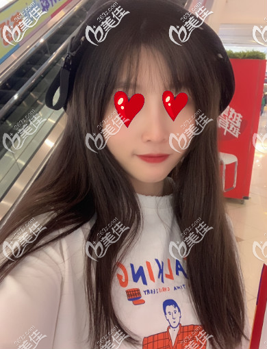 青島諾美德假體隆鼻兩個(gè)月的樣子 青島諾美德假體隆鼻兩個(gè)月的樣子