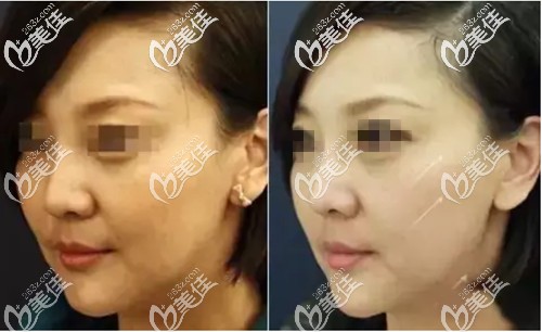 從不同年齡人群做埋線提升效果來看術(shù)后沒有副作用 也不會越來越老