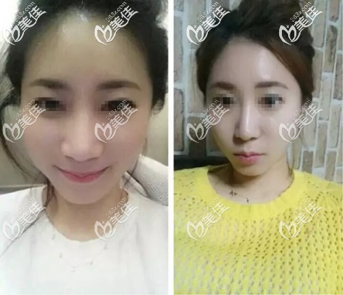 25歲做埋線提升手術效果對比 25歲做埋線提升手術效果對比