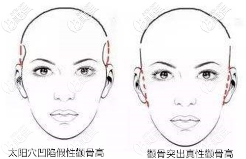 顴骨高和太陽穴凹陷的區(qū)別 顴骨高和太陽穴凹陷的區(qū)別