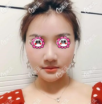 面部埋線提升術后1周效果照 面部埋線提升術后1周效果照