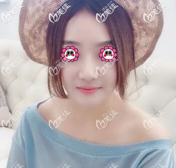 真實經(jīng)歷：找長沙希美醫(yī)療美容做面部埋線提升2個月了，給大家看下恢復效果怎么樣？