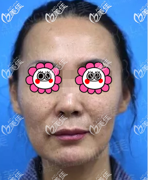 做V美減齡V9面部提升術前 做V美減齡V9面部提升術前