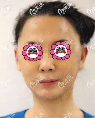 我做V美減齡V9再生青春術一周了 我做V美減齡V9再生青春術一周了