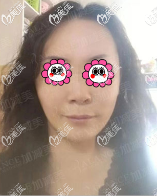 v美減齡V9面部提升半個月樣子 v美減齡V9面部提升半個月樣子