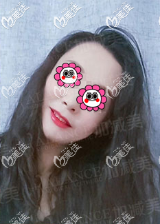 黃寅守面部提升手術怎么樣?我做v美減齡V9提升效果參考 黃寅守面部提升手術怎么樣?我做v美減齡V9提升效果參考