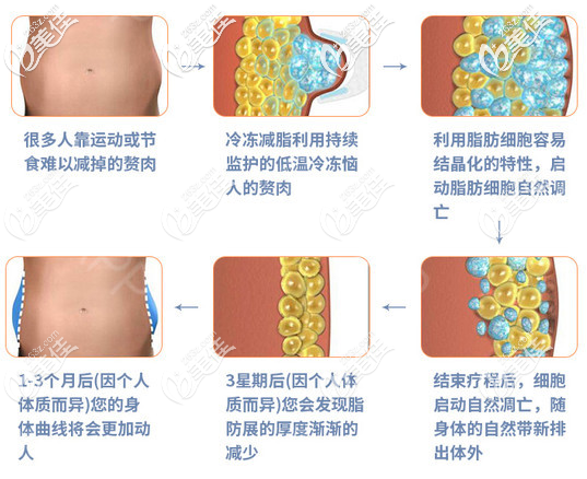 酷塑冷凍溶脂的原理圖片 酷塑冷凍溶脂的原理圖片