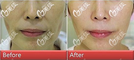 面部埋線提升后的對(duì)比 面部埋線提升后的對(duì)比