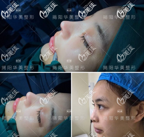 揭陽(yáng)華美張全鎮(zhèn)隆鼻案例