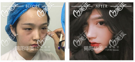 揭陽(yáng)華美雙眼皮案例
