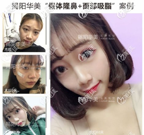 揭陽(yáng)華美張全鎮(zhèn)隆鼻和面部吸脂案例