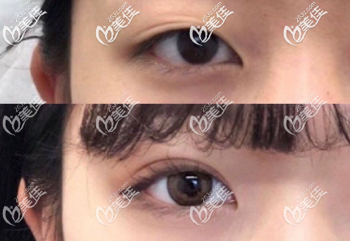 揭陽(yáng)華美張全鎮(zhèn)做的雙眼皮案例