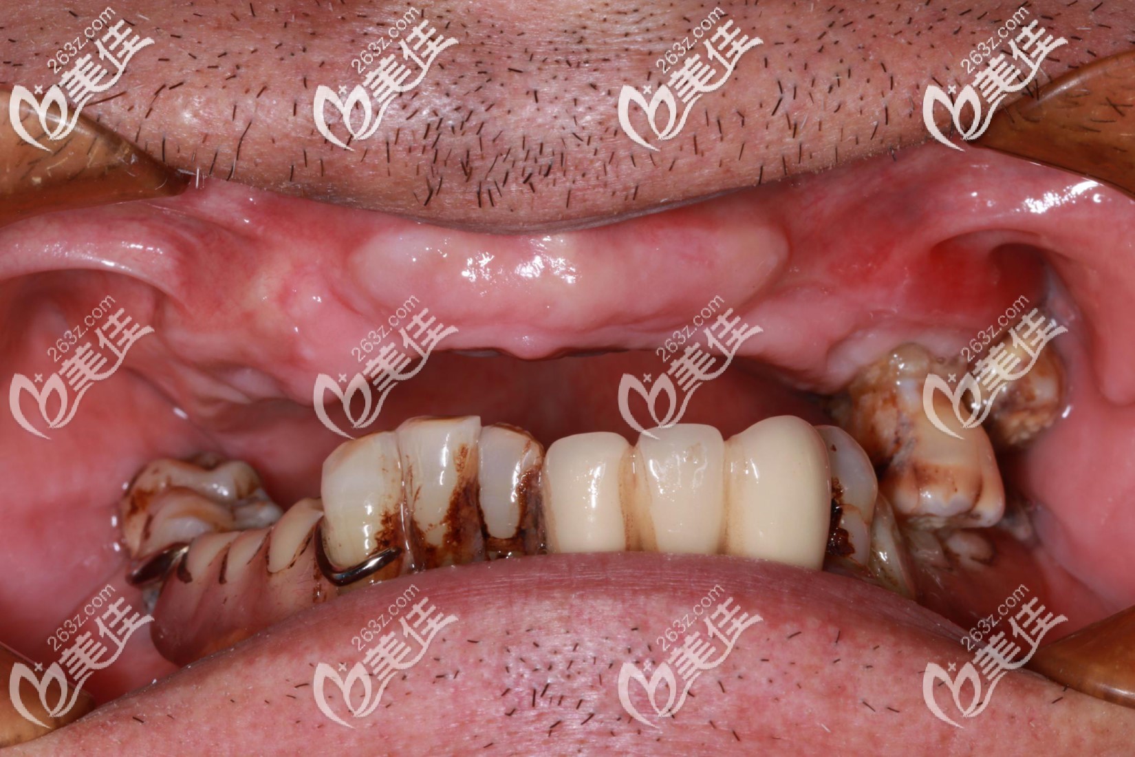 65歲老爸在成都錦江口腔連鎖做上半口allon4即刻種植牙選擇是瑞典諾貝爾植體而不是iti，和價(jià)格無關(guān)