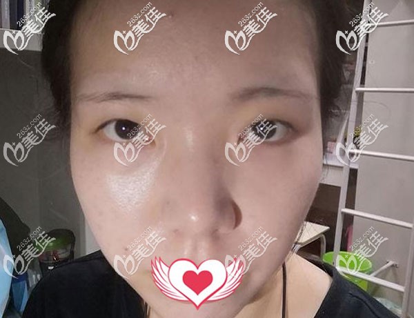 割雙眼皮手術(shù)前 割雙眼皮手術(shù)前