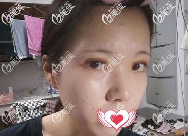 做雙眼皮第7天拆線后有點(diǎn)腫 做雙眼皮第7天拆線后有點(diǎn)腫