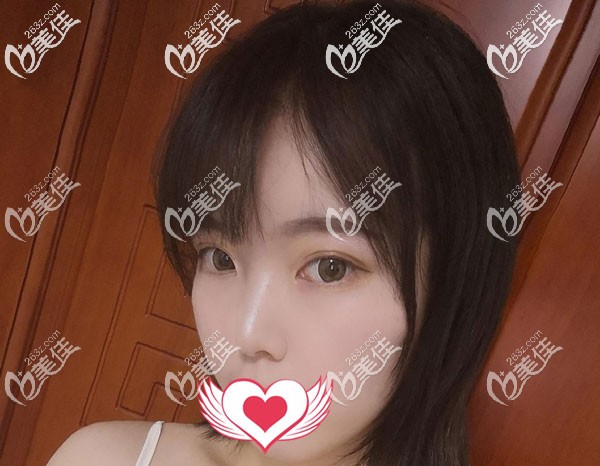 眼綜合一個(gè)月沒有出現(xiàn)疤痕增生 眼綜合一個(gè)月沒有出現(xiàn)疤痕增生