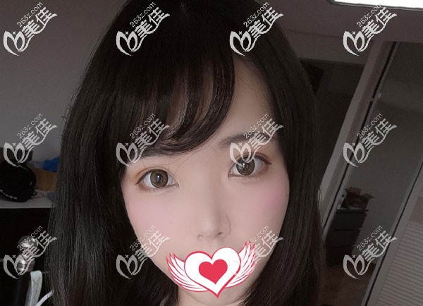 切開雙眼皮2個(gè)月恢復(fù)的很自然 切開雙眼皮2個(gè)月恢復(fù)的很自然