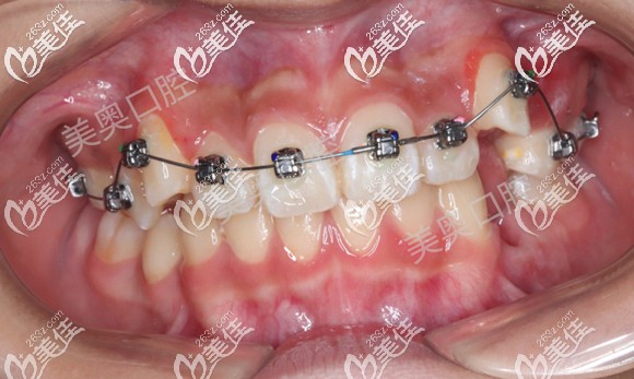 14歲青少年矯正前的口內(nèi)照 14歲青少年矯正前的口內(nèi)照
