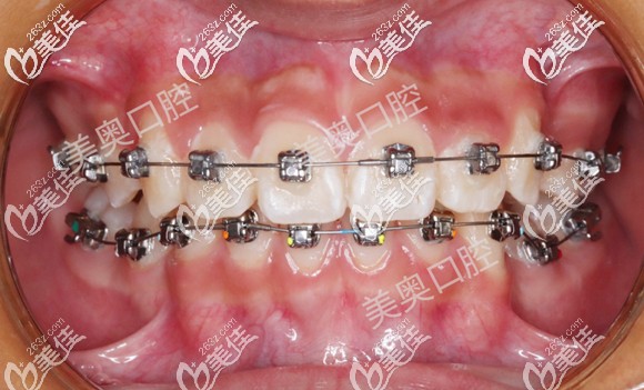青少年在常州美奧口腔矯正牙齒6個(gè)月的效果 青少年在常州美奧口腔矯正牙齒6個(gè)月的效果