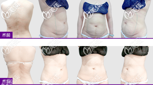 腰腹部減脂瘦身